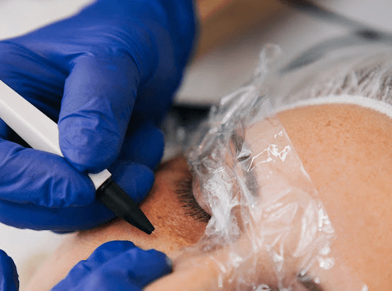 Plasma pen-behandling hos Drakenrous Beauty i Stockholm